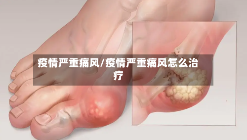 疫情严重痛风/疫情严重痛风怎么治疗-第2张图片